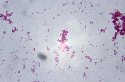 Gonorrhoea bacteria
An electron micrograph of...