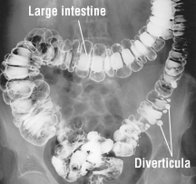 Diverticulitis and diverticulosis - Credo Reference